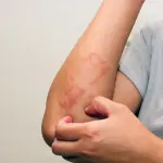 L'eritema della pelle